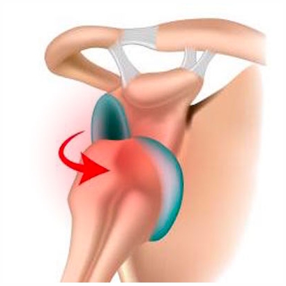 Shoulder dislocation treatment and stabilisation surgery